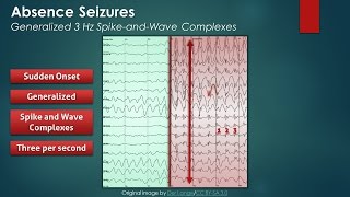 Absence Seizures EEG Findings [upl. by Marb996]