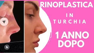 RINOPLASTICA operata in Turchia 1 anno fa ecco il mio naso oggi [upl. by Asilla]