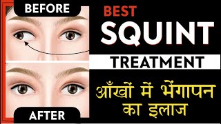 Best Squint treatment  Causes Symptoms amp Treatment of Squint  strabismus  भेंगापन का सरल इलाज [upl. by Esmerelda]