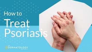 Psoriasis Treatment  Explained by Dermatologist [upl. by Gregorio]