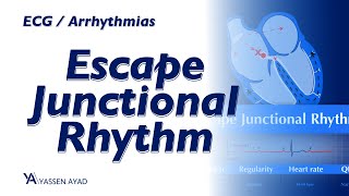 ECG 54  Escape Junctional Rhythm [upl. by Maddox]