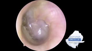 Perforated Purulent Otitis Media  Otite moyenne purulente perforée [upl. by Eadahc]