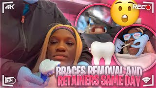 Braces REMOVAL and RETAINERS SAME DAY [upl. by Nnodnarb778]