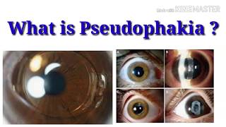 What is pseudophakia  sign  Intraocular lens  sharp vision [upl. by Anawk]