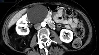 Liposarcoma [upl. by Bruce]