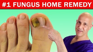 1 Best Home Remedy Cure for Toenail Fungus Dr Mandell [upl. by Norrat]