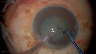 Surgery Phacoemulsification in Posterior Subcapsular Cataract [upl. by Mcgrody]