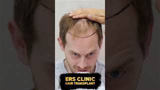 We are waiting for you at our ERS Clinic for the highest quality hair transplantation sacekimi [upl. by Vasta]