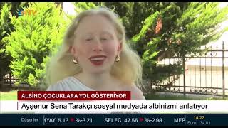 NTV Röportajı  Albino Olmak albinizm albino [upl. by Gunzburg704]