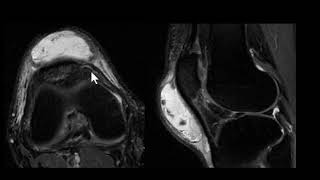 prepatellar bursitis [upl. by Lugo]