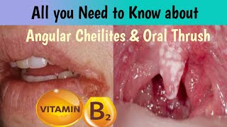 angular cheilitis  mounh ka pak jana  oral thrush  which vitamin u need in this condition [upl. by Suoivatco]