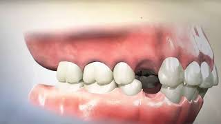 Removing Teeth for Braces  Why Extracting and Retracting Orthodontics is harmful [upl. by Efrem]