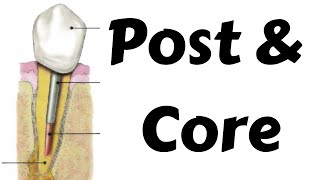 Post amp Core post preparation procedure in endodontic amp prosthodontics Step by step Dentsply calibra [upl. by Fredette]