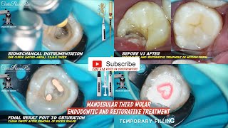 CLINICAL CASE ENDODONTIC amp RESTORATIVE IN MANDIBULAR THIRD MOLAR❗️PERAWATAN SALURAN AKAR GIGI BUNGSU [upl. by Kylynn]