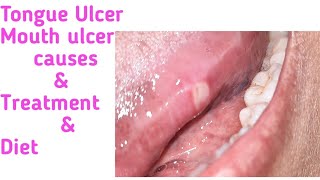 Tongue Ulcer Mouth Ulcer How to cure [upl. by Akimrehs]