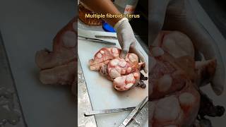 Multiple fibroid uterus specimen [upl. by Eiznek6]