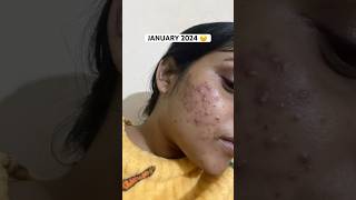 How I cleared my Acne  Acne journey  Get rid of acne  Adult Acne  Products that helped me [upl. by Aili]