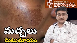 Cure Melasma  Liver spots  DrSomayajula Homeopathy  HealthGuruTelugu [upl. by Rainah]