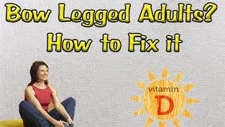 Why do Bow Legged Adults is Caused and How to Fix it [upl. by Ennovad]