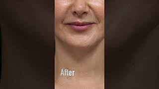 A Perfect Jawline For Your Face beforeandafter cosmeticsurgery [upl. by Johnson]