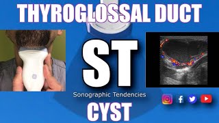 Sonoquickie Thyroglossal Duct Cyst [upl. by Atiuqehs]