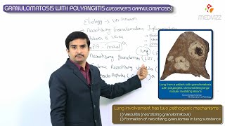 Granulomatosis with polyangiitis  Wegeners granulomatosis  Usmle step 1 vascular Pathology [upl. by Elmo908]