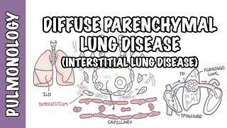 Interstitial Lung Disease ILD  Classification pathophysiology signs and symptoms [upl. by Peddada]