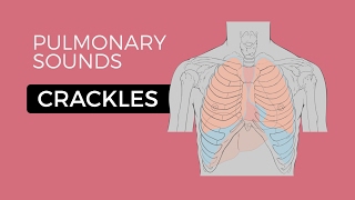 Crackles or Crepitations  Quick amp Easy Overview Easy Lung Sounds [upl. by Parsifal299]