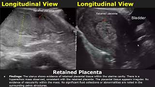 Postpartum Uterus Ultrasound Reporting  RPOCRetained Placenta Scan Reports  Pelvic USG [upl. by Rabassa28]