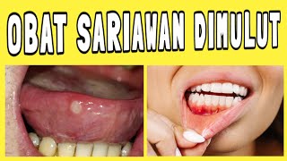 Sariawan  Penyebab dan Pengobatan  Nystatin [upl. by Dremann]