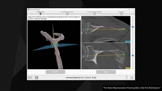 Equinoxe Shoulder Planning Application Creating a Case amp Immediate Reconstruction [upl. by Fen954]