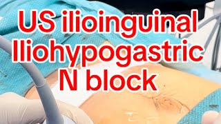 US guided Ilioinguinal iliohypogastric ns block [upl. by Sinnal]