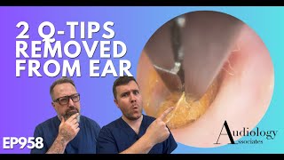 2 QTIPS REMOVED FROM EAR  EP958 [upl. by Johanna]