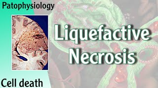 Pathophysiology  Liquefactive Necrosis Hani Laith شرح [upl. by Arick9]