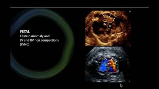 Fetal Ebstein noncompaction [upl. by Hsima]