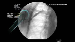 Arrow® EZIO® System  Proximal Humerus Infusion Fluoroscopy Adult Alert Patient [upl. by Aimit]