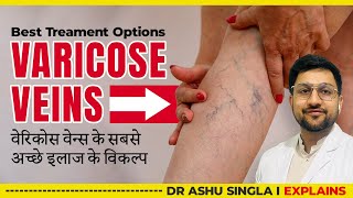 Varicose Veins Best Treatment Options  Ligation Stripping Laser Options Explained [upl. by Nisa391]