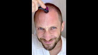 How I Use DermaRoller for Hair Growth and To Solve my Baldness and Hair Loss Tutorial 4k [upl. by Felicidad]