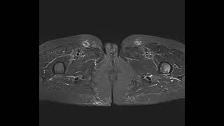 Atypical fracture hip both [upl. by Acihsay953]