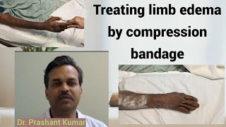 Treating limb edema by compression bandage [upl. by Enhpad]