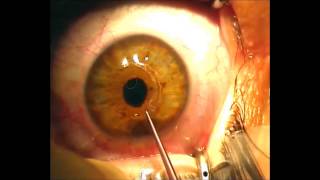 Implantation of Intrastromal Corneal Ring Segments for Keratoconus [upl. by Scandura]