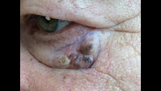 Basal Cell Carcinoma  Face Skin Cancer [upl. by Epp]