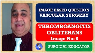 THROMBOANGITIS OBLITERANS  VASCULAR SURGERY  Image Based Question [upl. by Mulvihill]