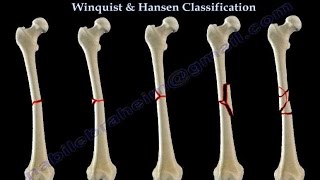 Fractures Of The Femur Shaft Winquist amp Hansen  Everything You Need To Know  Dr Nabil Ebraheim [upl. by Gurney439]