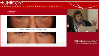 Endolift In The Area Of The Eyes  The Oculoplastic Approach  Dr Renata Migliardi [upl. by Aredna]