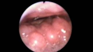 Epiglottis Schnarchen [upl. by Wally]