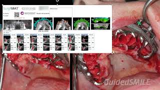 GuidedSMILE Dentate Natural Single Maxillary  Hamill [upl. by Airenahs]