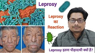 Lepromatous Leprosy  Leprosy का Reaction  Leprosy इतना पीड़ादायी क्यों है Hansens Disease कुष्ट [upl. by Beller]