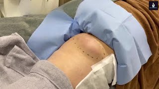 Huge Creamy Epidermal Cyst Incision and Drainage [upl. by Wight989]