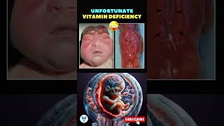 Neural tube defect due to folic acid deficiency  Vitamin deficiency in Pregnancy trending vitamin [upl. by Hecht]